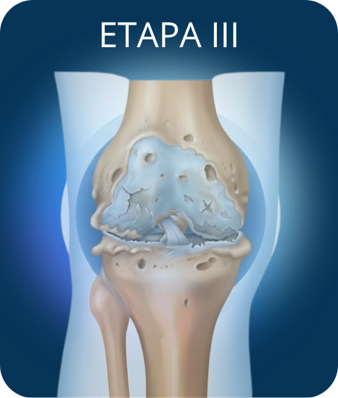 Cartilago etapa 3